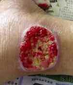 Figure 1. Before application of PRP, the wound was 6 cm in diameter.