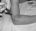 4x above baseline 2-3 ml of either PRP or bupivacaine (control) were injected using a 22-g needle into the common extensor tendon Mishra, A et al; Treatment of Chronic Elbow Tendinosis with Buffered
