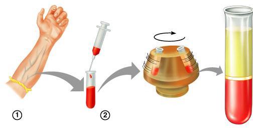 If blood is treated to prevent clotting and permitted to stand in a container, the red blood cells, which weigh more than the other components, will settle to the bottom; the plasma will stay on top;