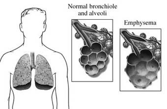 Emphysema Anatomic and Functional Changes Loss of lung elasticity Hyperinflation of the lung Emphysema - Etiology Cigarette smoking (90%) Air pollution Occupational substances (coal dust)