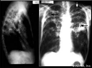 Pulmonary Tuberculosis Pathophysiology Lung infection caused by: Mycobacterium tuberculosis Acid-fast bacillus, Gram- positive, bacteria Any tissue can be infected but most commonly found in the