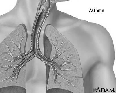 Reactive Airway Disease