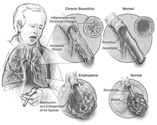 Chronic Obstructive Pulmonary Disease Chronic Bronchitis Inflammation and scarring of