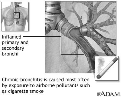 to loss of elasticity These two conditions can co-exist Chronic Bronchitis Chronic