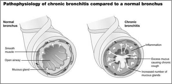 Pathophysiology Chronic Bronchitis Cilia damaged Cannot clear airway Increased airway