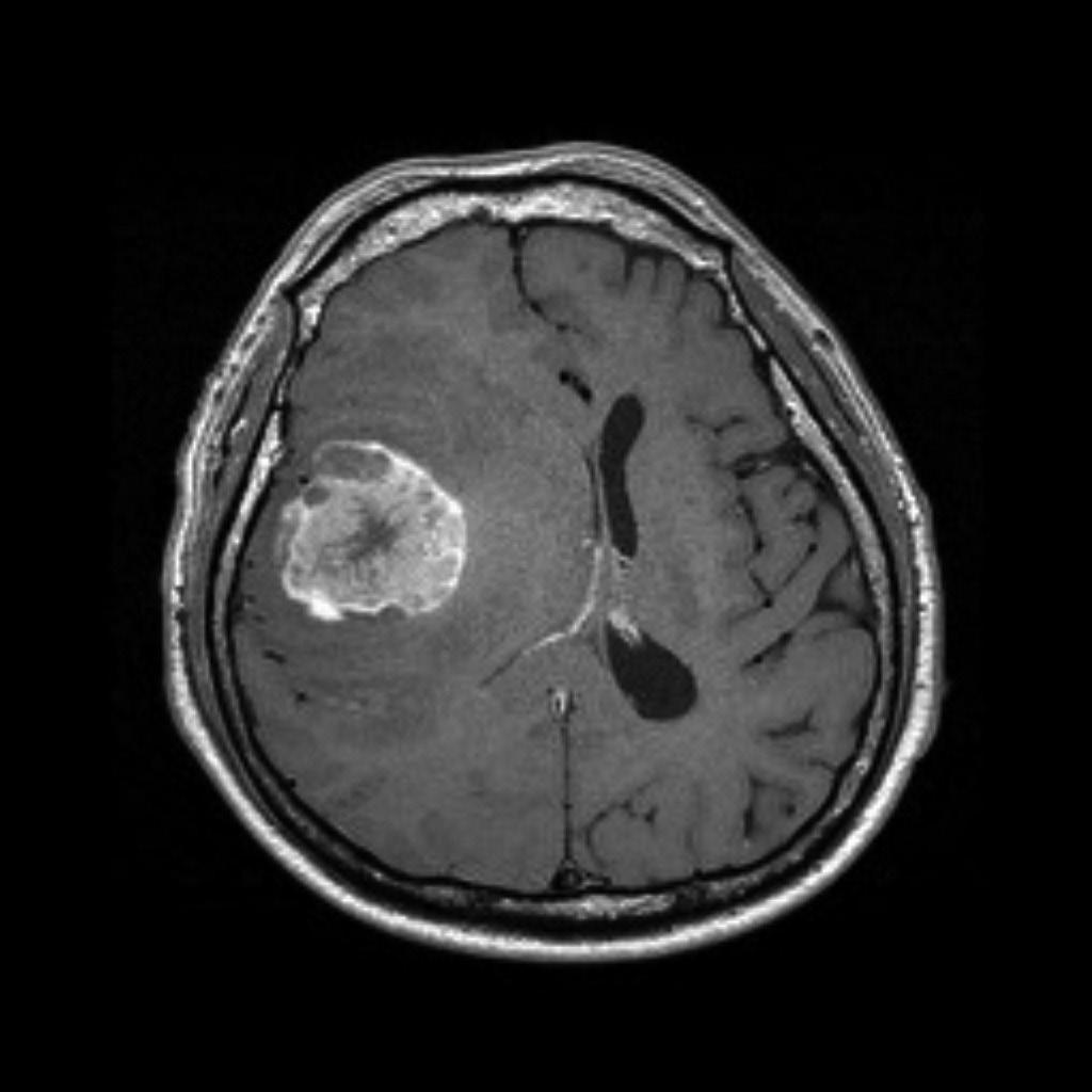 Brain Metastasis from Hepatoma A B C D Fig. 4. A: Preoperative MRI revealed a metastatic brain tumor at right frontal lobe with tumor bleeding.
