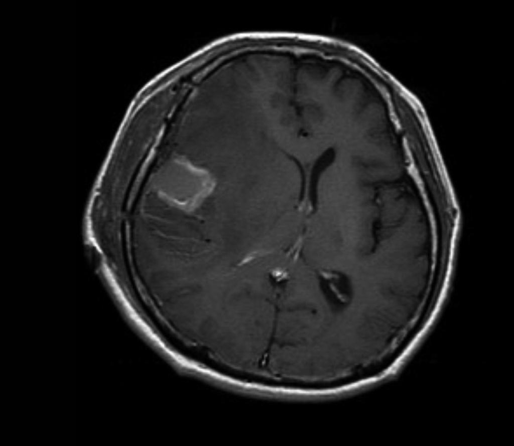 D: Follow-up MRI (two months after operation) revealed that the tumor had recurred along the resection margin. After that, further gamma knife radiosurgery was done.