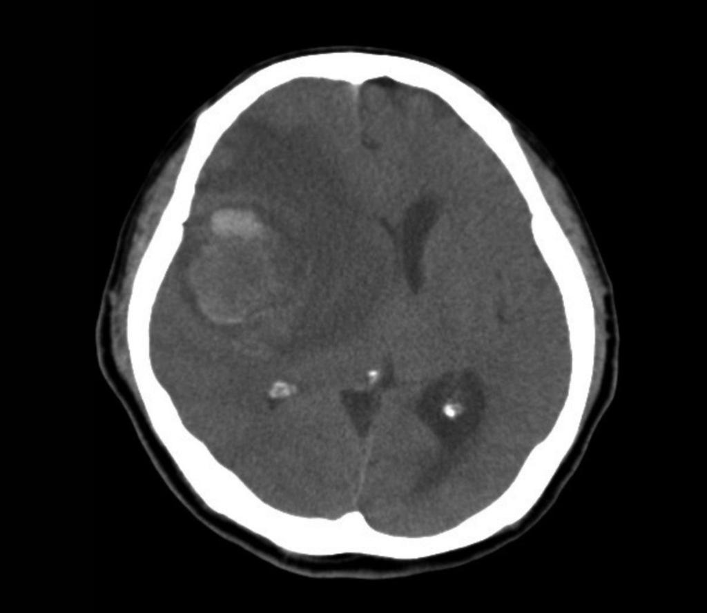 adrenal glands, and occasionally the peritoneum, pancreas, or kidney. There are some reports on the incidence of brain metastasis from HCC.