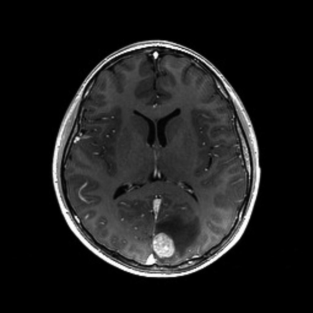 TY Park et al. A B C Fig. 5. A: Pre-GKS MRI revealed a metastatic brain tumor at the left occipital lobe.