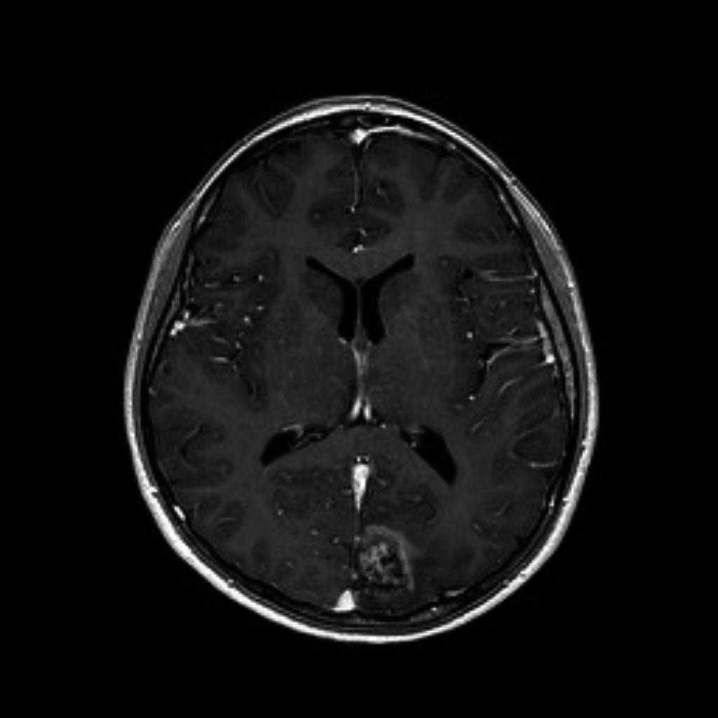 GKS: gamma knife radiosurgery. Jiang et al. [21] reported 46.3% of patients (19/41) with brain metastasis from HCC experienced tumor bleeding. In our study, 33.