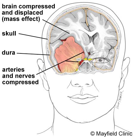 Brain tumors are named after the cell type from which they grow. They may be primary (starting in the brain) or secondary (spreading to the brain from another area).