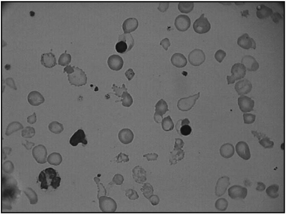 Hemolytic Anemia Due to Abnormal Hemoglobin Synthesis 4. Platelet count is normal. May be decreased if there is pooling in the spleen. 5. Peripheral blood smear (Fig. 19.