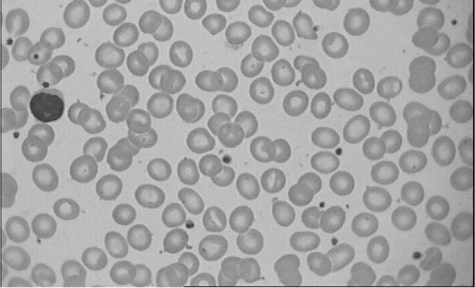 MODULE Hemolytic Anemia Due to Abnormal Hemoglobin Synthesis 19.3.3 Treatment 1. Blood transfusions to maintain Hb 10.5 to 11.0g/dL 2. Chelation of iron 3. Bone marrow transplantation 19.