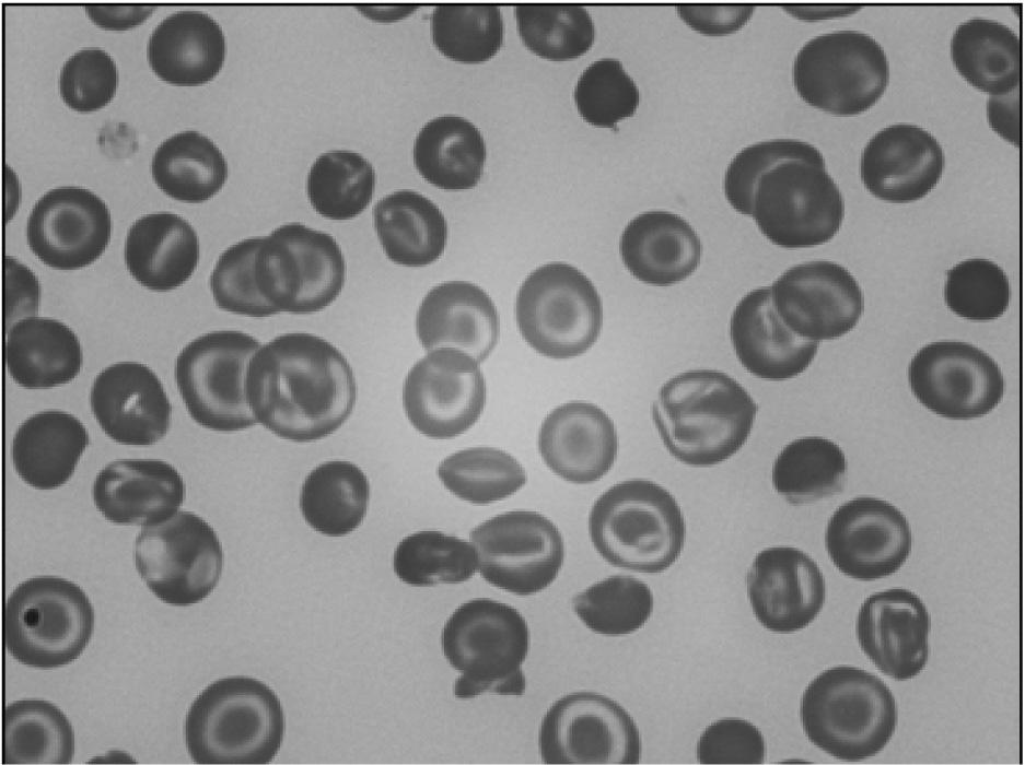 Hemolytic Anemia Due to Abnormal Hemoglobin Synthesis MODULE Fig. 19.6: Haemoglobin C INTEXT QUESTIONS 19.1 1. β thalassemia is inherited as... disorder 2. Thalassemia minor causes... anaemia 3.