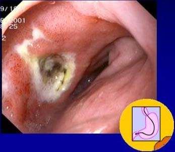 Peptic Ulcers