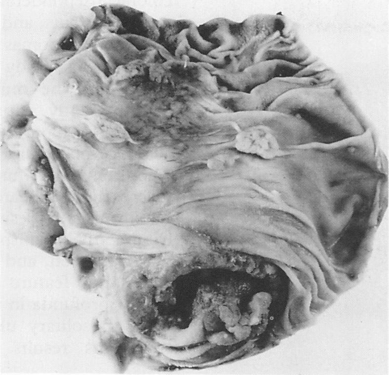 Inverted hyperplastic polyposis 57 Figure 1 Case 1: the right hemicolectomy specimen contains an ulcerating tumour in the caecum (below), a lipoma in the proximal ascending colon (centre), and