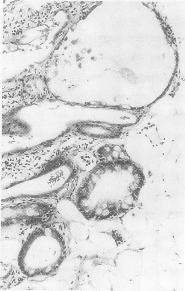 Figure 4 Case 1: the intimate association between hyperplastic epithelial tubules and submucosalfatty tissues. JFe,:r t: 3 + jl s, Jw t 1: B SR w.. t...fi...... 3F '.?t'::..^ *._,.,.lf ': 4 :. {.K.. i..>.