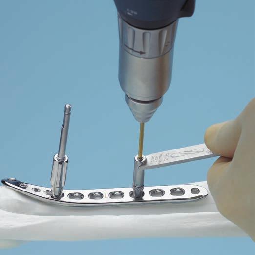 Screw Insertion 8 Insert screws in proximal fragment A Non-locking screws Instruments 310.250 Drill Bit B 2.5 mm 323.360 Universal Drill Guide 3.5 314.070 Screwdriver hexagonal 314.
