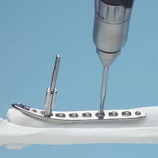 Measure for screw length using the depth gauge for small screws. Select and insert the appropriate cortex screw B 3.