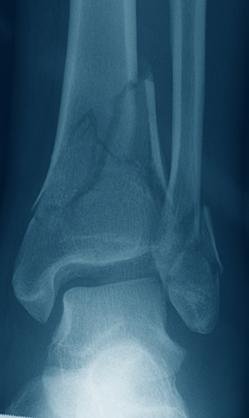Indications The LCP Anterolateral Distal Tibia Plate 3.