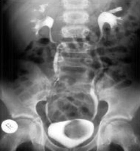 Bilateral reflux extending into the pelvicalyceal systems of the kidney without dilatation of the calyces or