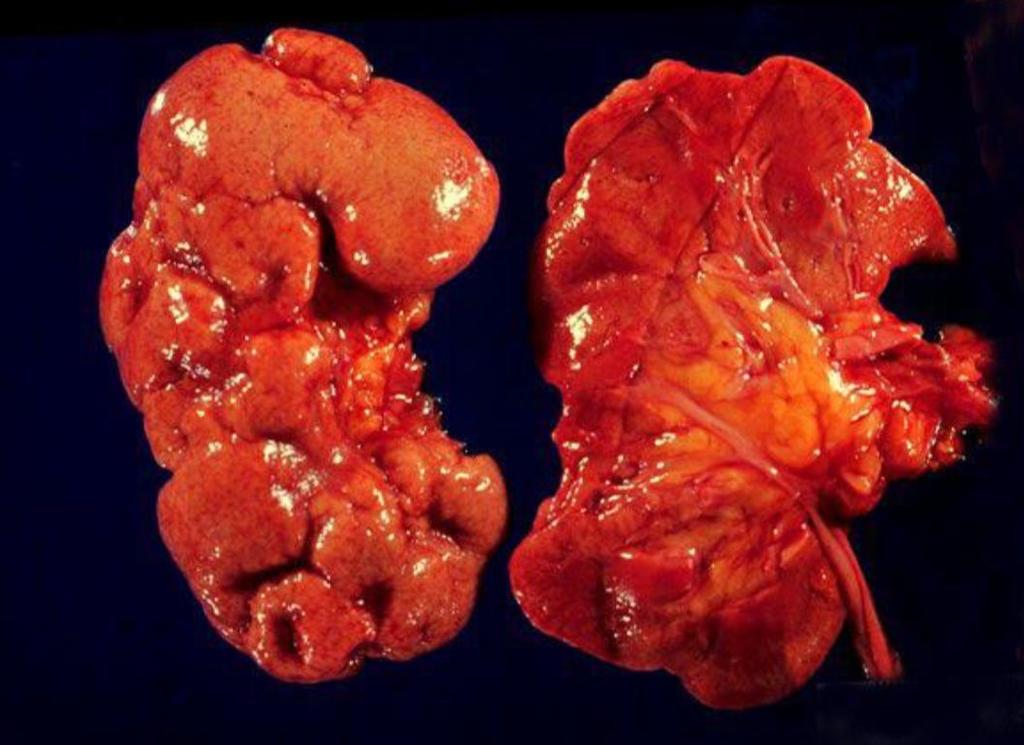 Chronic Pyelonephritis Repeated bouts of acute pyelonephritis may lead to chronic pyelonephritis that damages the kidney and