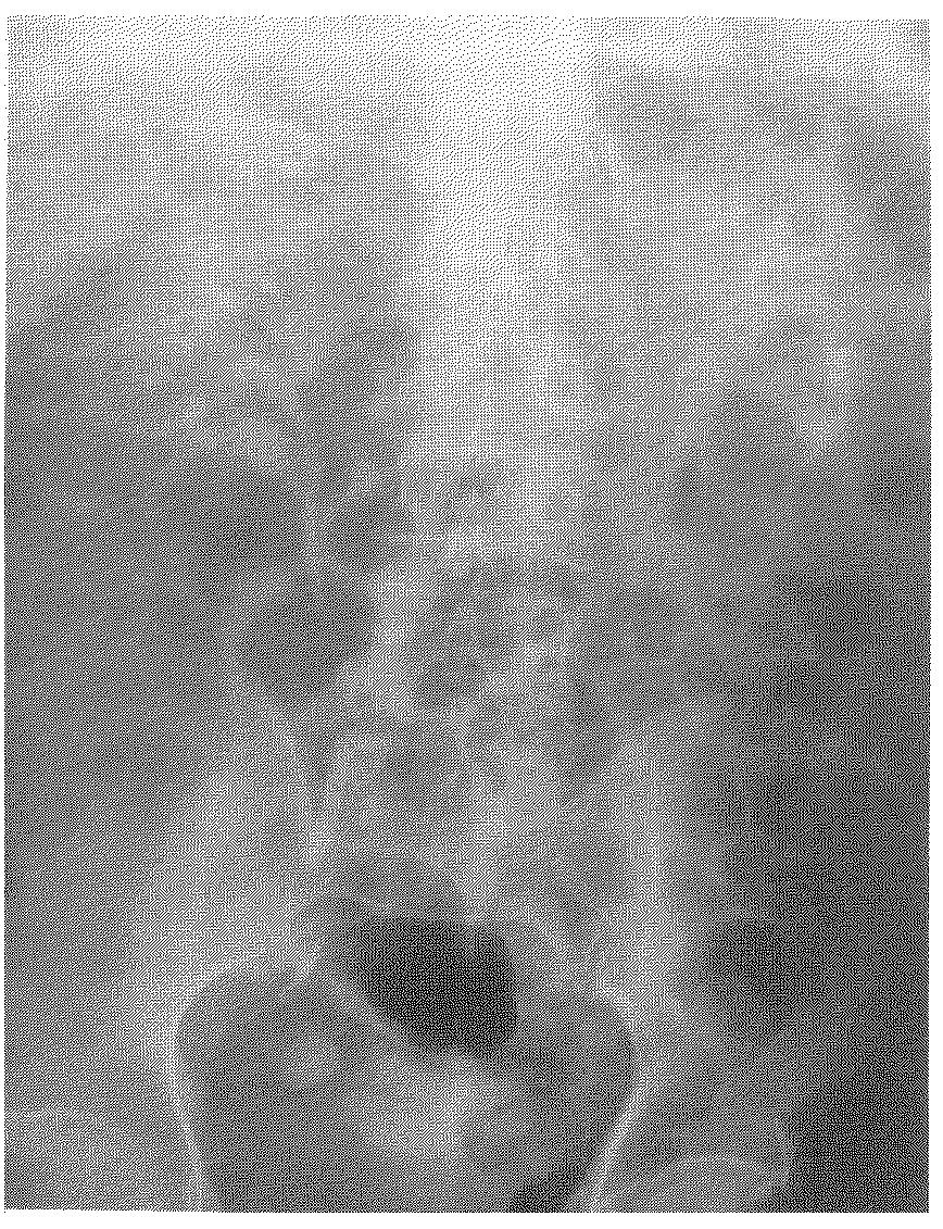 168 H. KAKIZAKI et al. renal pelvic stone that caused right flank pain and febrile urinary tract infection. At that time the left renal stone had been pointed out.
