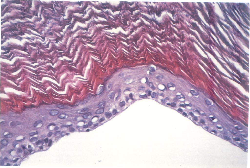 LEUKOPLAKIA OF THE RENAL PELVIS keratinization (Fig. 3). The pathological diagnosis was leukoplakia of the renal pelvis, and no malignant change was documented histologically.