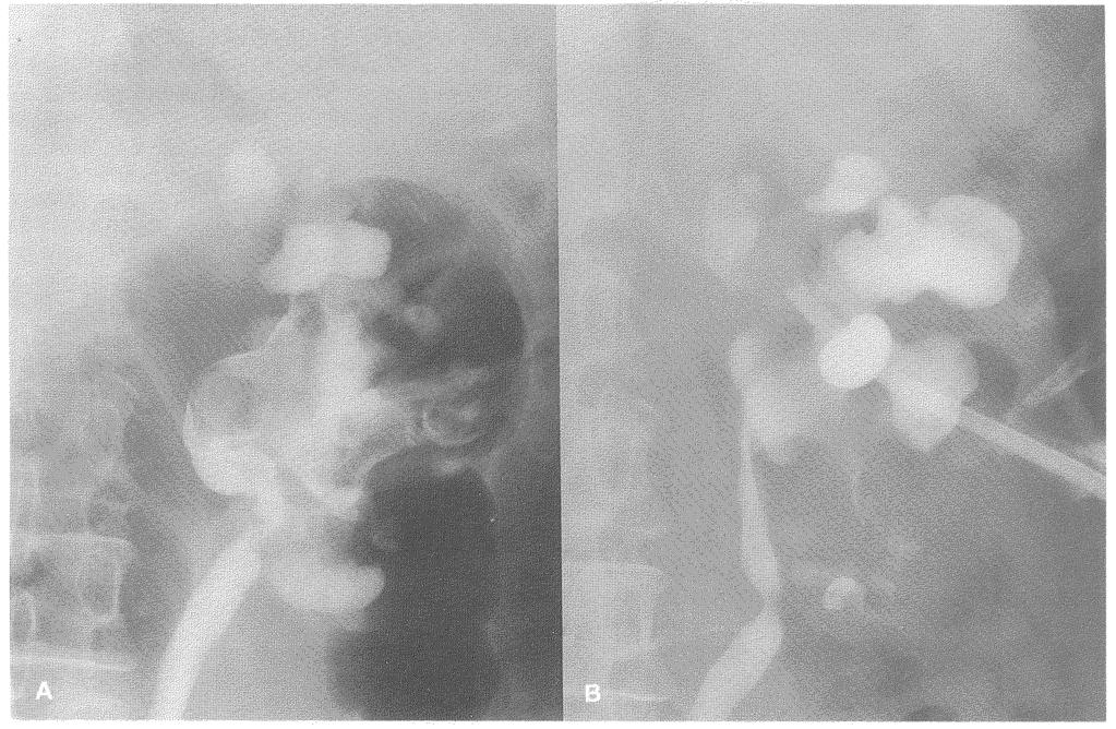 170 H. KAKIZAKI et al. Figure 4 A. Retrograde pyelography in Case 2, demonstrating multiple filling defects in the renal pelvis and middle calyces. B.