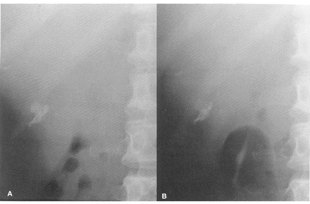 172 H. KAKIZAKI et al. Figure 6 Plain radiography in Case 3. A. Before ESWL. B. After ESWL. The stone shadow was not significantly changed after ESWL. ditions were present in 40%.