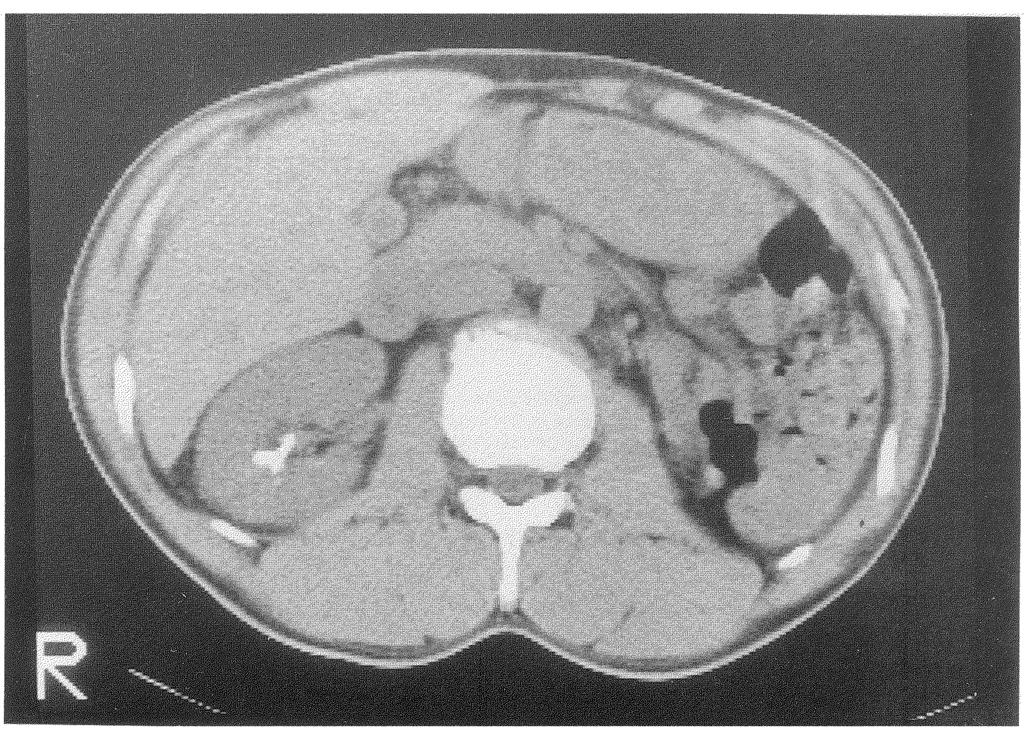 LEUKOPLAKIA OF THE RENAL PELVIS 173 Figure 7 CT scan after ESWL in Case 3. No intrapelvic lesion other than the stone was not noted.