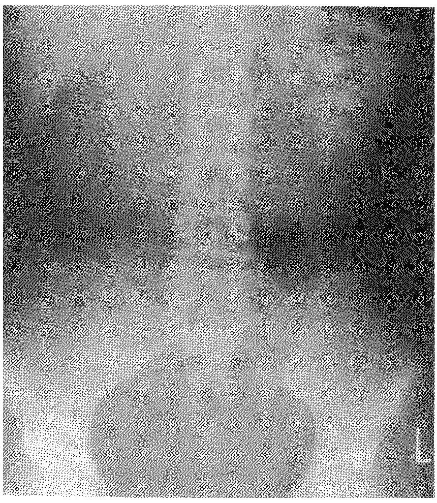 calyceal diverticulum (16). Furthermore, some investigators suggest that selected cases of renal pelvic transitional cell carcinoma might be amenable to percutaneous endourological resection (17,18).