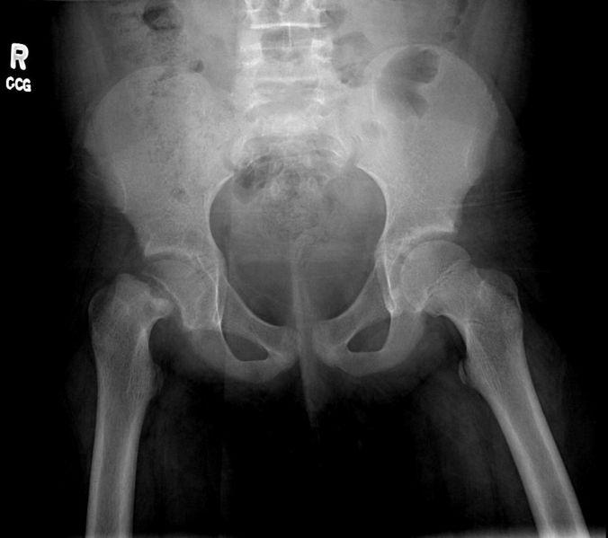 Slipped Capital Femoral Epiphysis (SCFE) Posterior/inferior slippage of prox fem epiphysis Adolescent obese males 25-40% bilateral