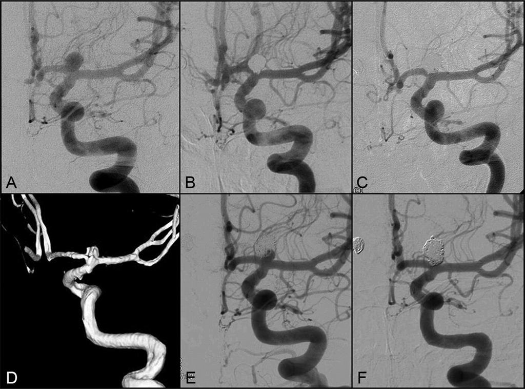 A 27-year-old woman with late reopening and retreatment of unruptured left internal carotid artery tip aneurysm.
