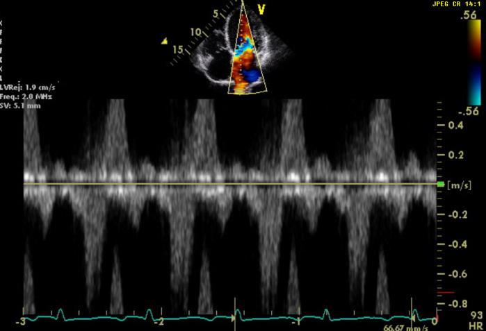 as systolic flow reversal in the pulmonary veins were used