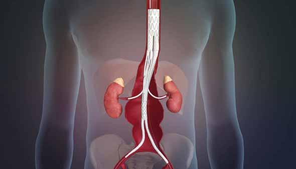 38 Market watch June 2015 Product News Medtronic to develop stent graft for thoracoabdominal aneurysms under patent license agreement with Sanford Health Medtronic announced on 14 April 2015 that it