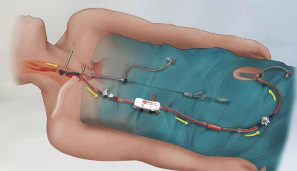 The Enroute transcarotid stent is the first carotid stent that is introduced and implanted into the carotid artery through a direct common carotid access point to enable a safe and more direct