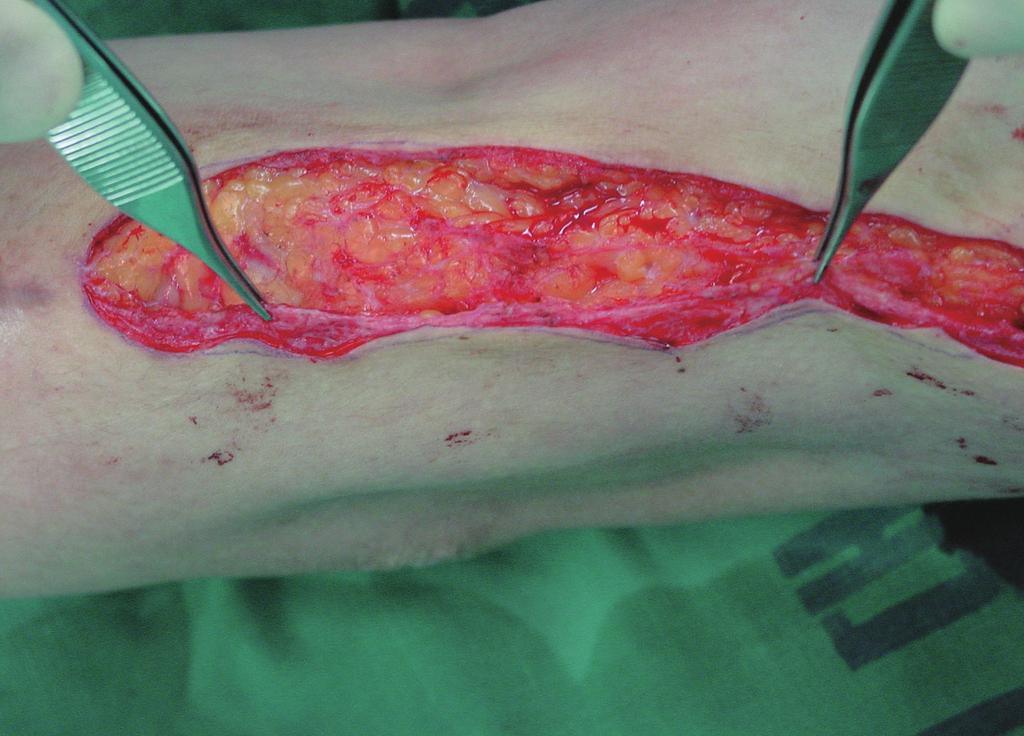 interrupted sutures, putting most of the wound tension at the