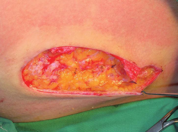 All techniques are based on the idea that stretching occurs mostly at the suture site, so additional coaptation of permanent dermal sutures will help wounds not to spread.
