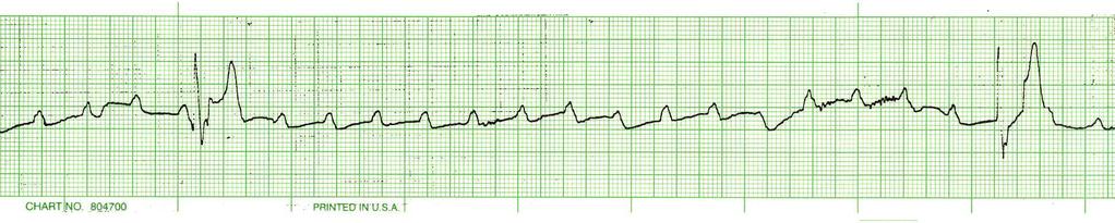 Lake EMS Basic EKG Review: Atrial