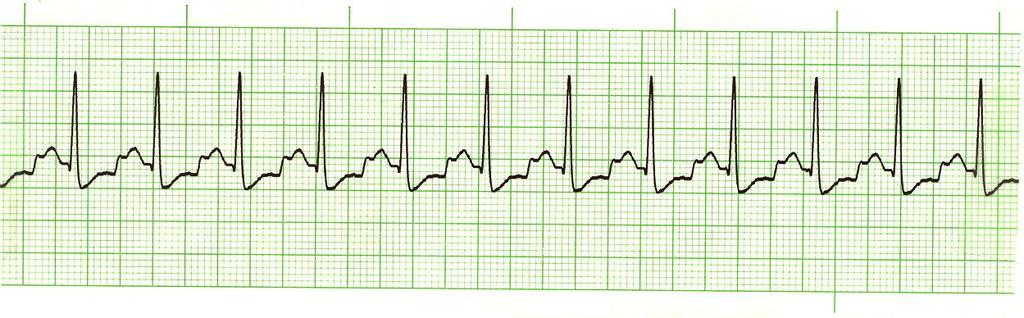 This is Sinus Tachycardia 1. Rate: 2. Rhythm: 3.