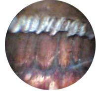 MS McFarland, MD Angle, Iris, Lens I also use the endoscope during procedures in