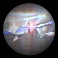 SJ Berke, MD, FACS Glaucoma Specialist Laser Treated Processes AC-IOL Piercing