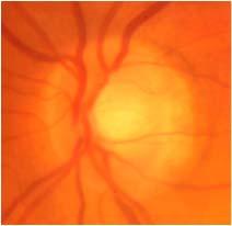 003 Glaucoma caused a -25% drop of blood flow in optic disc Jia Y, Wei E, Wang X, Zhang X, Morrison JC, Parikh M, Lombardi LH, Gattey DM, Armour RL,