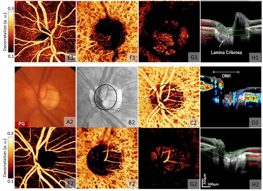 Glaucoma reduces perfusion at multiple levels of optic nerve head Jia Y, Wei E, Wang X, Zhang X, Morrison JC, Parikh M, Lombardi LH, Gattey DM, Armour RL, Edmunds B, Kraus MF, Fujimoto JG, Huang D.