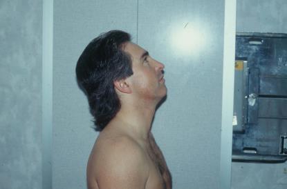 Chin elevated and head and neck extended backward to patient tolerance.