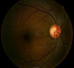 Optic Nerve Examination 2013 Pupillary Light Reflex Testing 42-year-old black male suspected of developing glaucoma