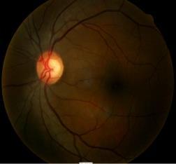 70 65 IOP = 26 mmhg IOP = 23 mmhg RAPDx pupillographer is designed to detect a relative afferent pupillary defect The