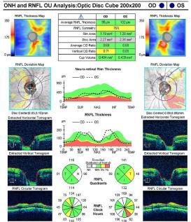 thickness in glaucoma diagnosis with fourier-domain optical coherence tomography. Journal of Glaucoma. 2011;20(2):87-94.