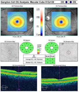 from two years earlier Ganglion Cell Complex 2015 30-2 Visual Field 2015 Ganglion cell complex analysis, both eyes No perifoveal thinning No clinically significant asymmetry Ganglion cell